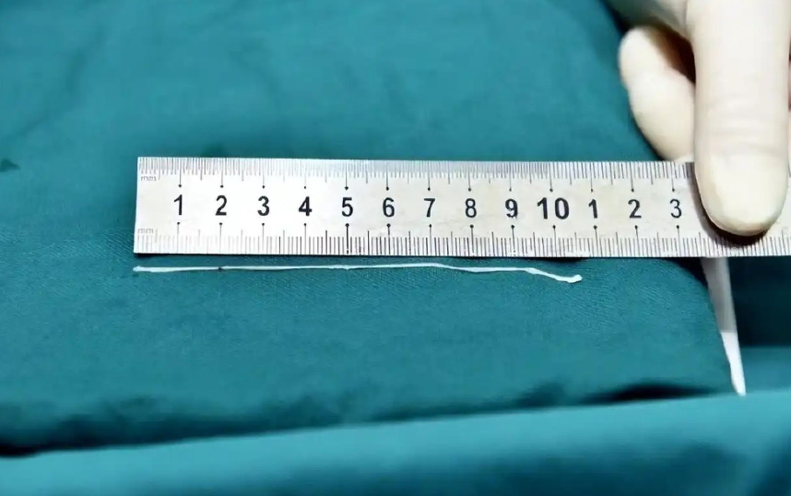 37歲男突「失語抽搐」醫驚：腦裡有10公分活蟲　取出還在蠕動
