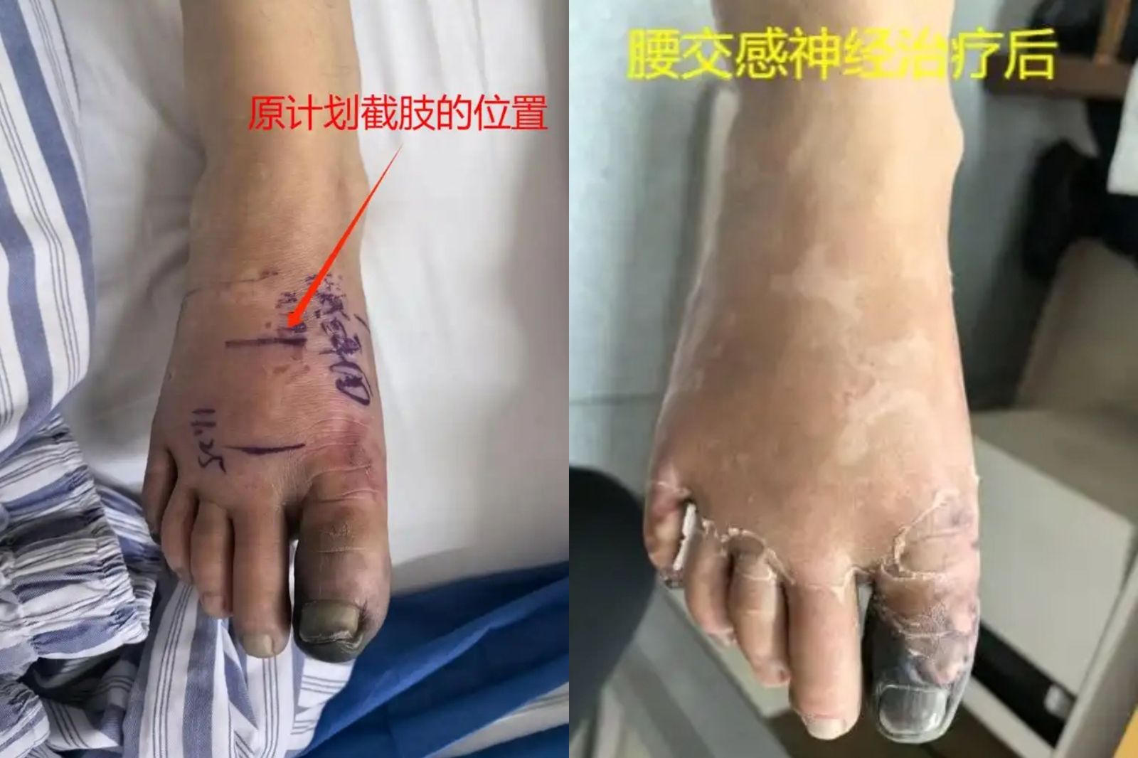 腳覺得冷！30多歲男腳趾發黑「差點截肢」　醫示警：常抽筋要小心