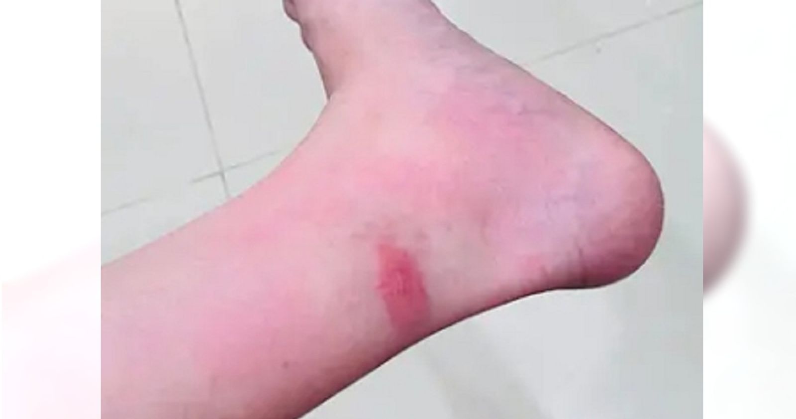 不要小看「蚊子咬的包」　護理師曝下場：差點要住院