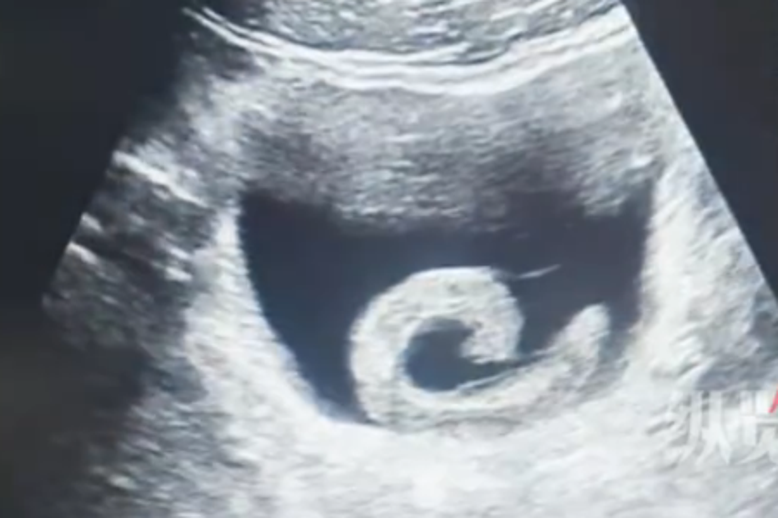 23歲男尿道塞「6公分活水蛭」痛炸後悔了！醫師傻眼：不健康行為五花八門
