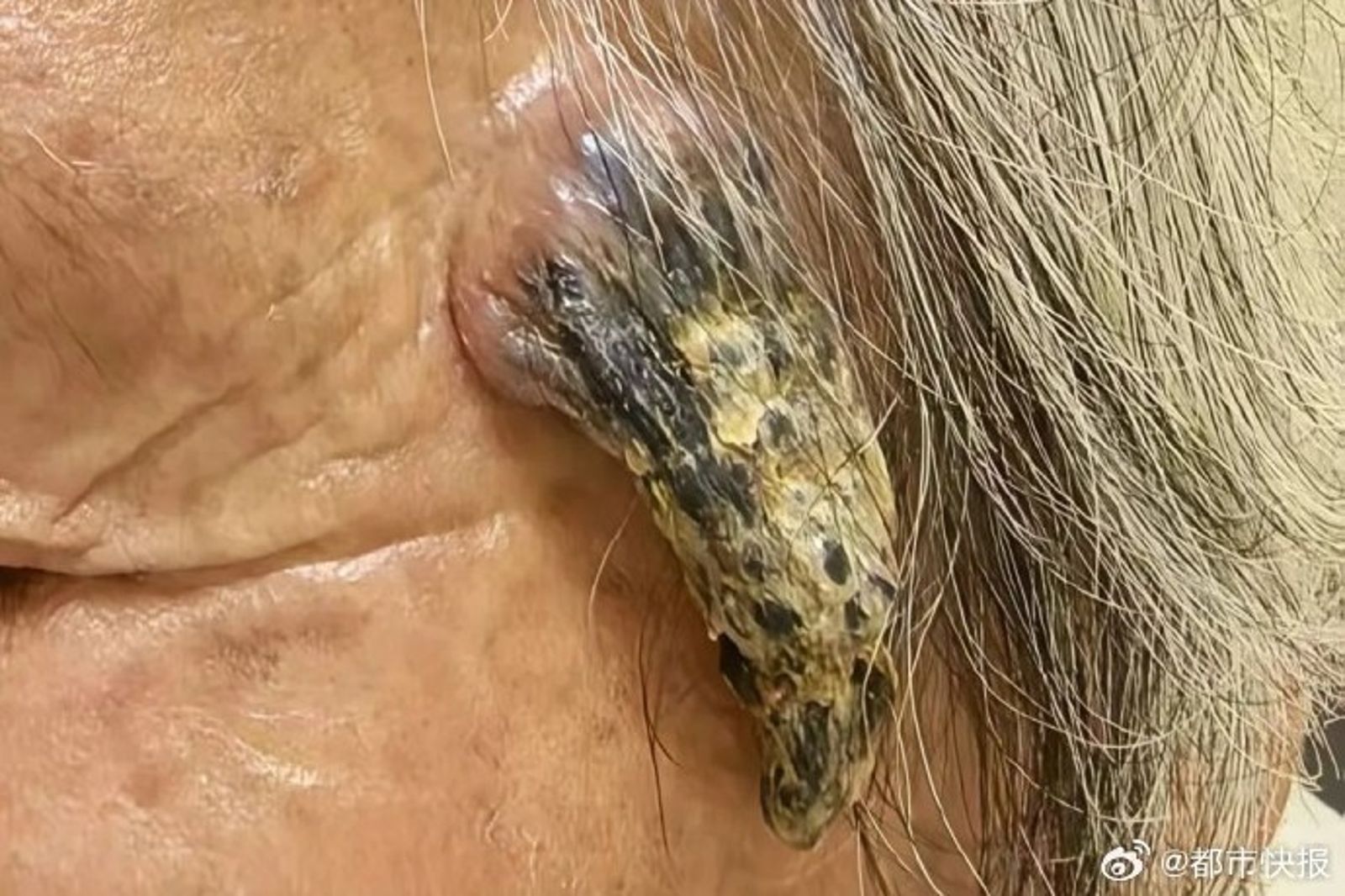 98歲嬤額頭長「羊角」竟自行剪掉!出現「1症狀」急送醫…專家警告:可能是癌症