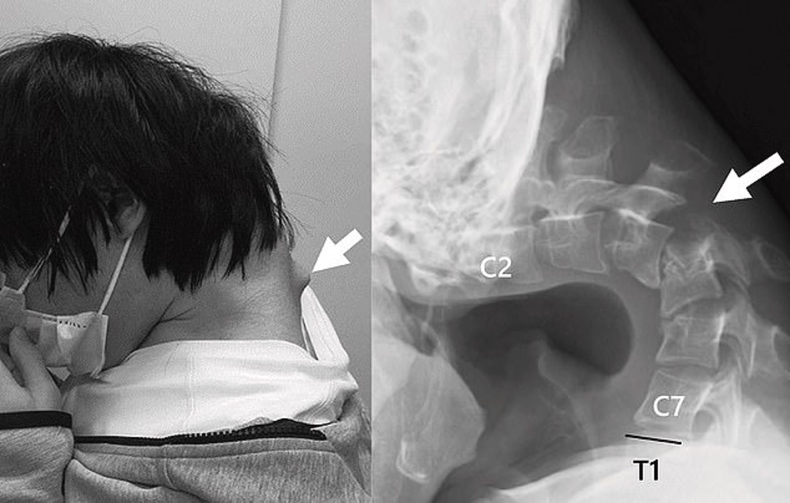 他「抬不起頭」！遭校園霸凌變宅男　長時間低頭玩手遊致頸椎嚴重變形