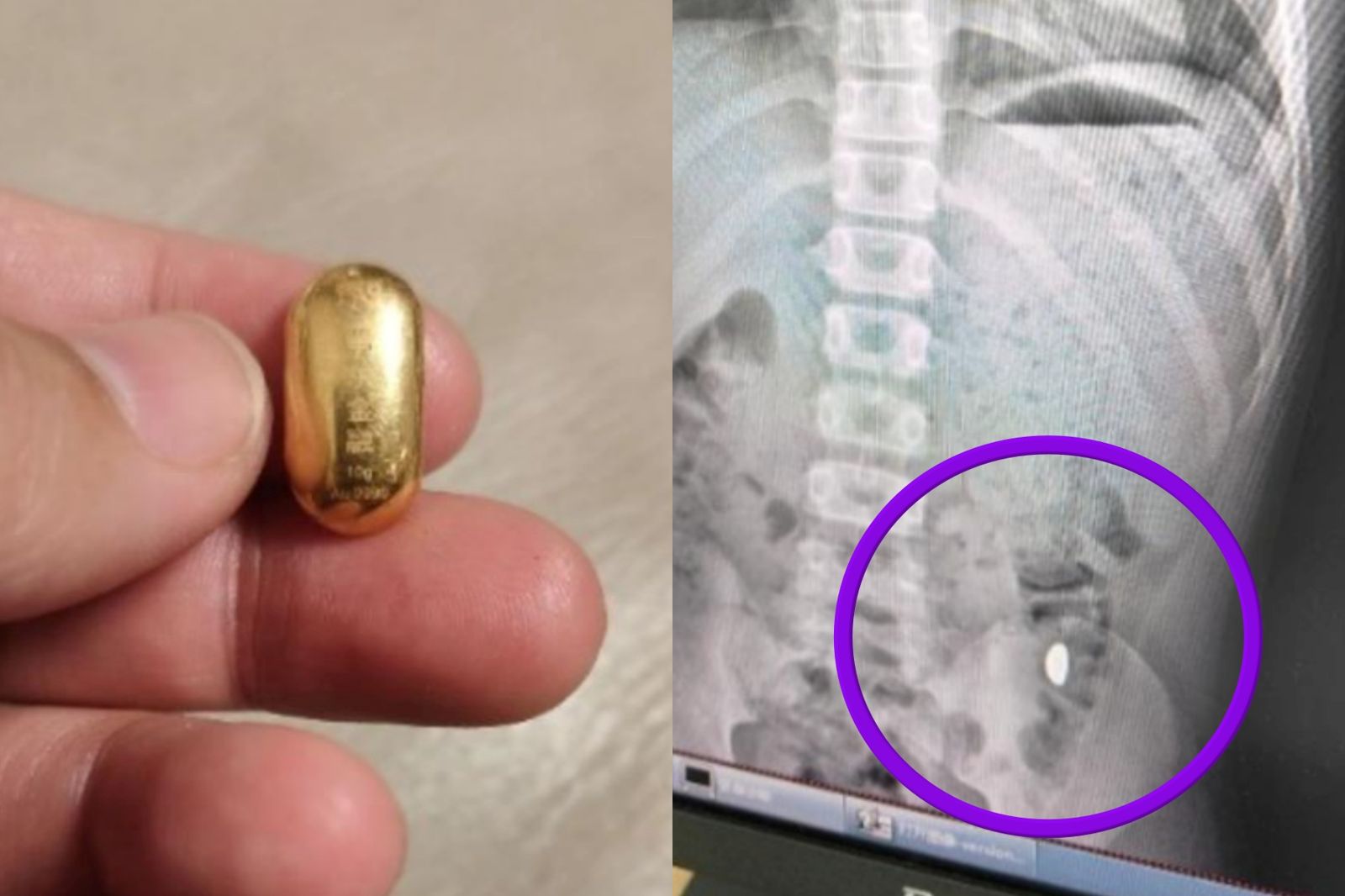 想鍛鍊舌頭「誤吞10克重黃金豆」!媽無奈叮嚀:不准在外「辦大事」