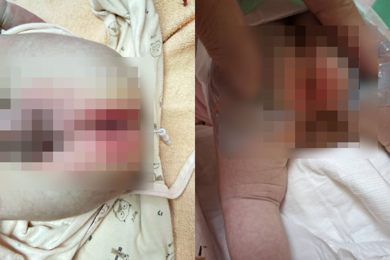 男嬰到院時,臀部紅屁股的情況相當嚴重。圖/家屬提供