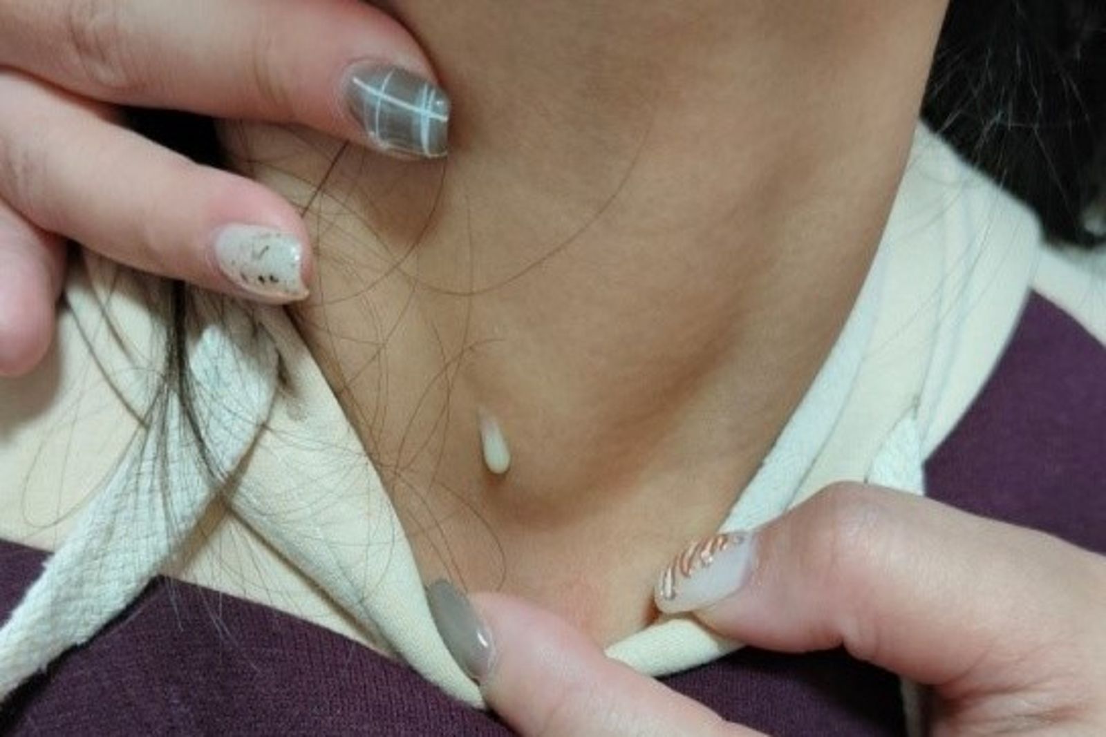 8歲女童頸部流膿惡臭！醫揭真相：鰓裂囊腫成年後恐惡化