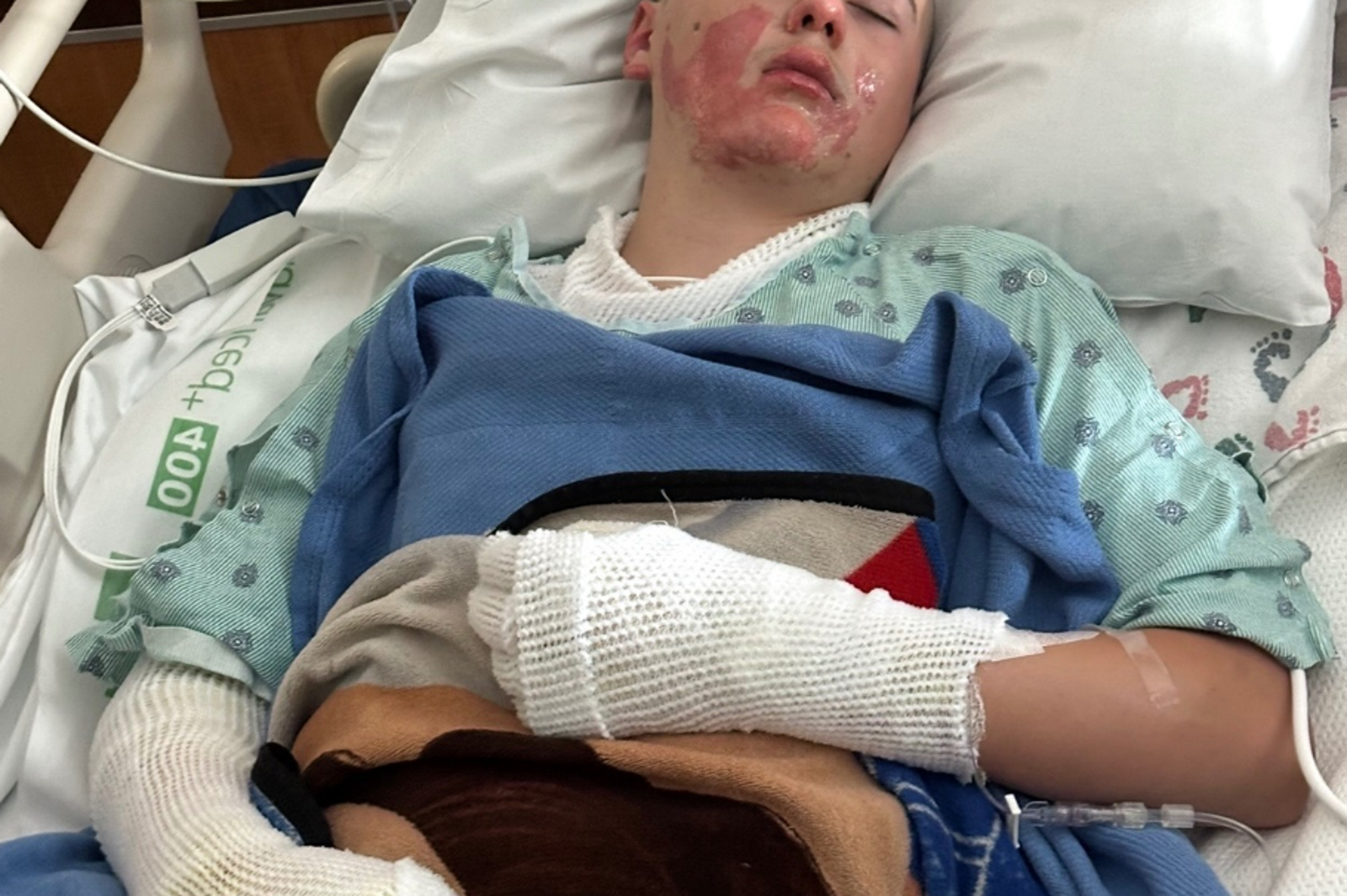 還酷嗎？12歲童玩「TikTok熱門挑戰」　釀身體11％燒燙傷　
