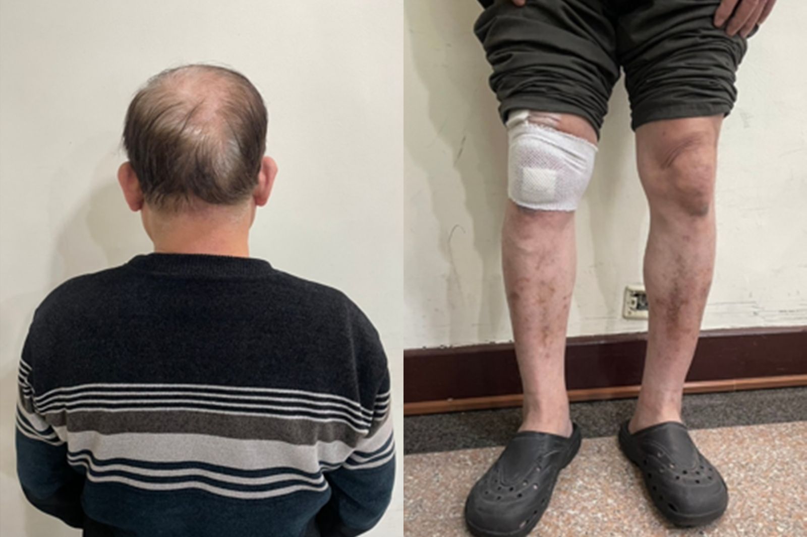 被告男子禿頭且小腿有新舊傷痕。圖／翻攝自判決書