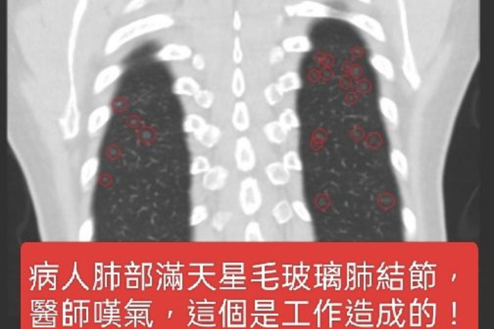 一上班就咳嗽！60歲婦滿天星肺結節　醫一聽「這工作」急勸：快轉行