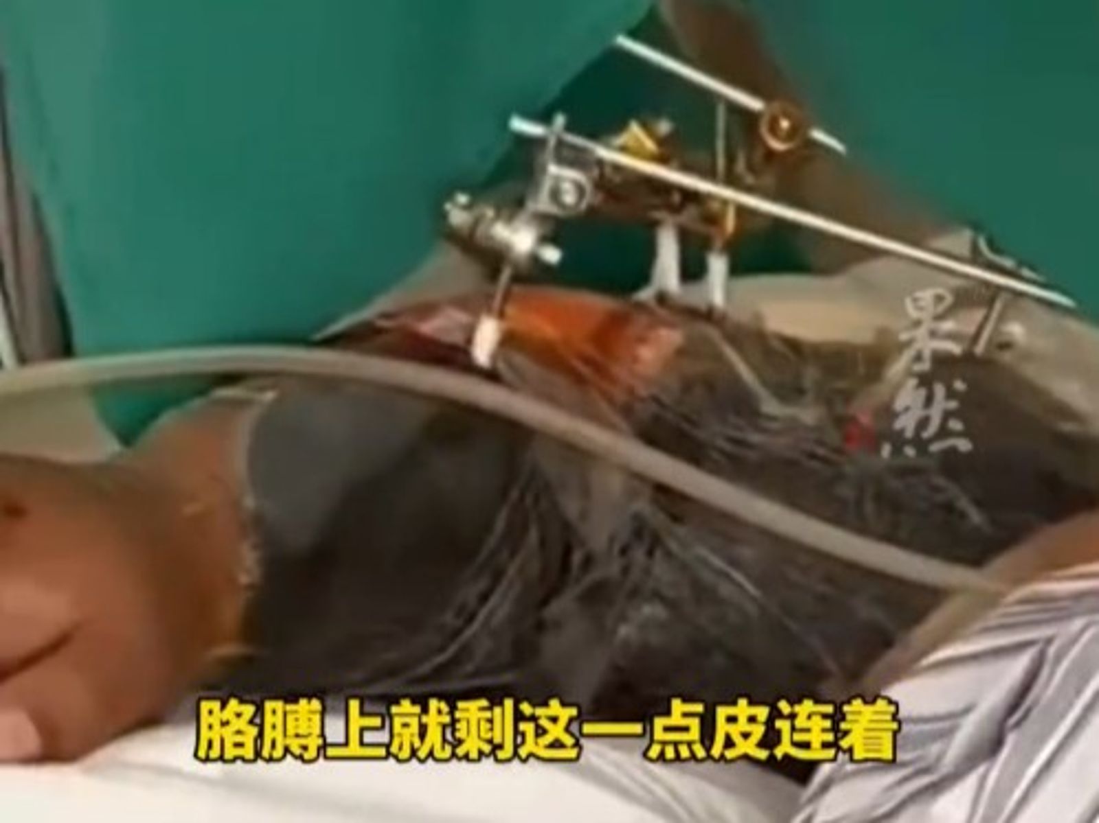 手伸出窗外趴睡…手臂下秒「遭貨車削斷成三截」!4小時手術奇蹟保住