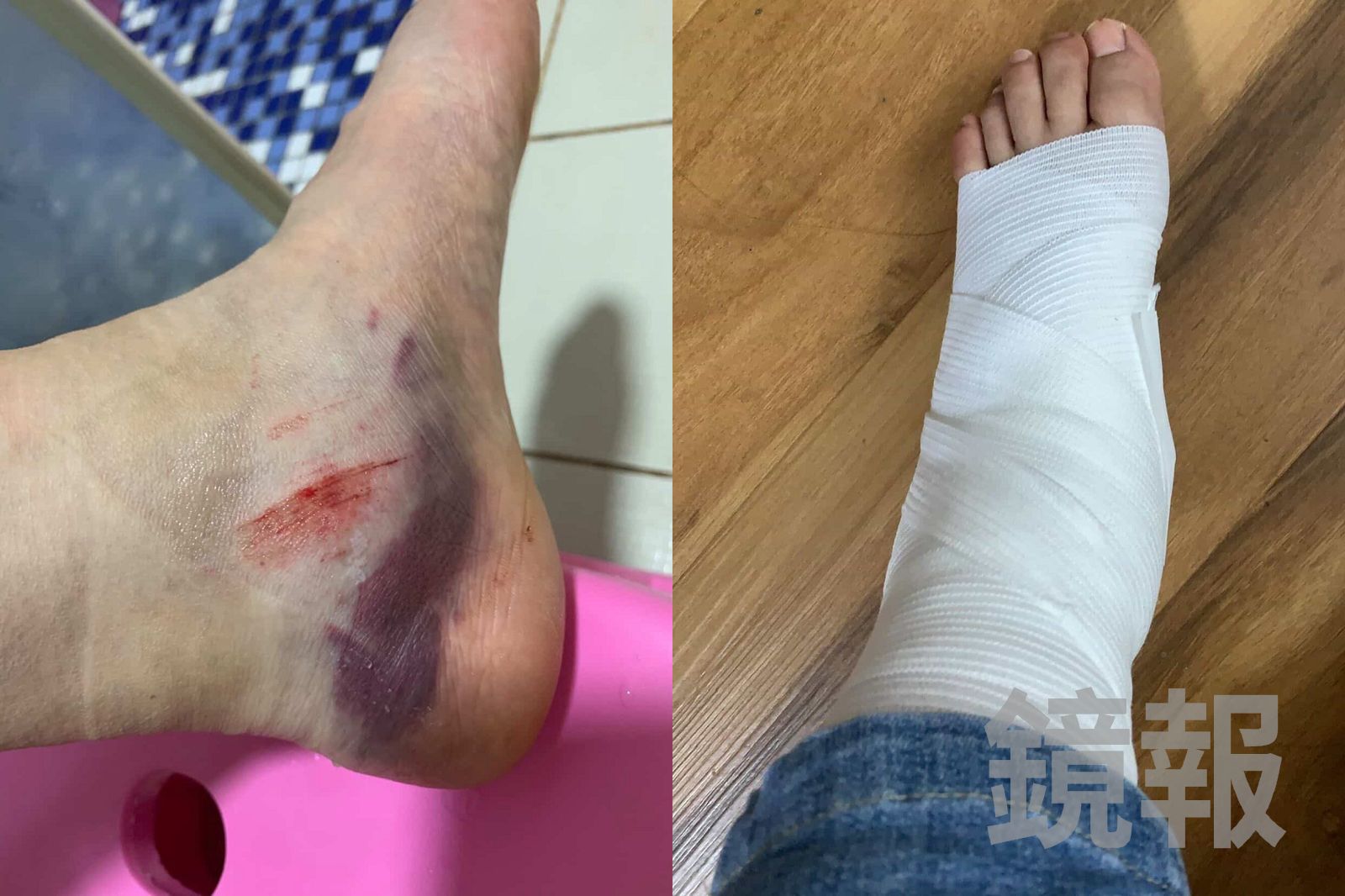 李小姐被停車格突起的水泥磚絆倒受傷，造成左腳骨裂與韌帶斷裂，生活與生計受到重大衝擊。李小姐提供