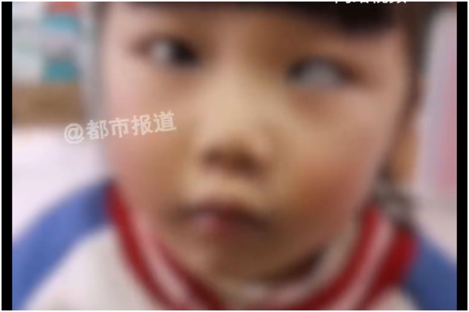 3歲童整個暑假「做這件事」慘變鬥雞眼！醫：恐造成終生傷害