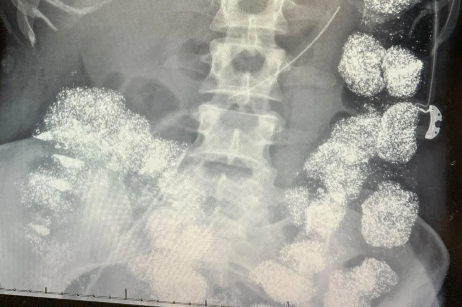 為奪1.5億保險金！他假好心天天餵妻吃「維他命」　腸子、骨頭全被鉛侵蝕中毒
